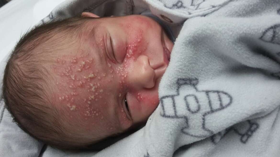 Herpes in Babies
